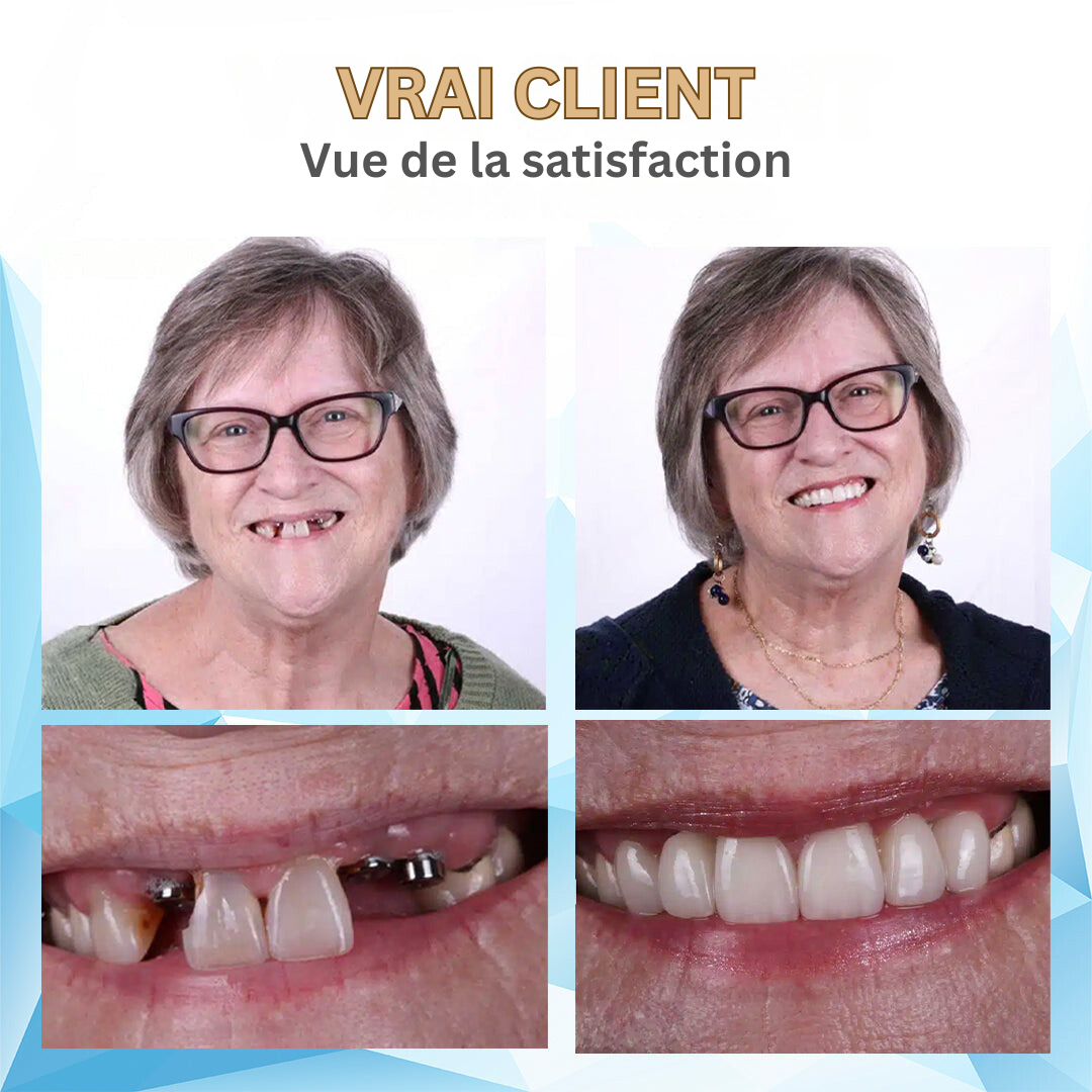 Kit de prothèses dentaires amovibles en silicone, haut et bas