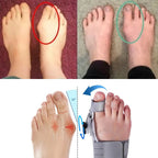 Correcteur d'orteil discret à porter dans la chaussure