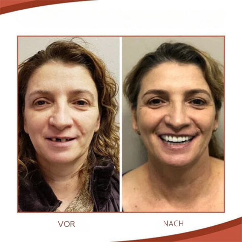 Prothèses dentaires souples en silicone, kit haut et bas
