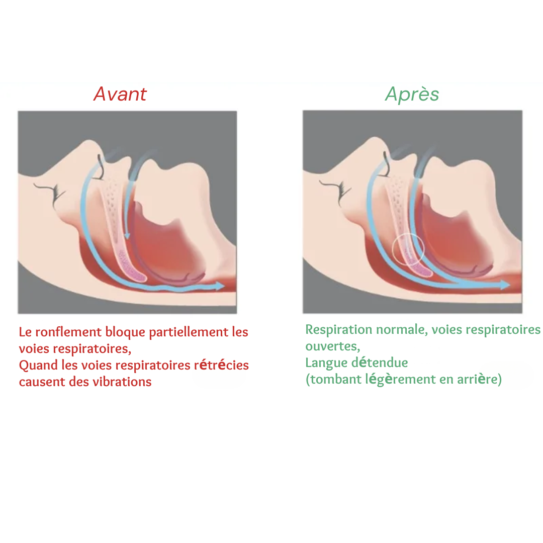 Gouttière de nuit en silicone souple, deux modèles